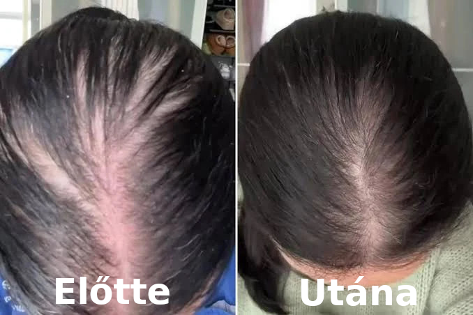 HajVital™ – Fejbőr és hajápoló masszírozó